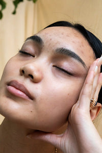 3 Natural Remedies for Hormonal Acne